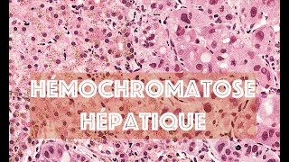 LHEMOCHROMATOSE HEPATIQUE partie 2  PATHOLOGIE [upl. by Hoashis]