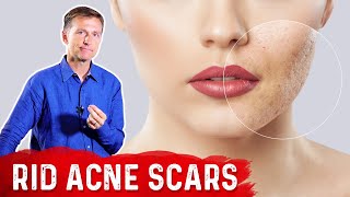 Acne scars Or Acne marks  how to treat  dermatologist suggests [upl. by Koralle]