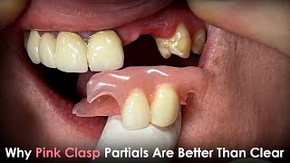 Why Pink Clasp Partials Are Better Than Clear Clasp Partials [upl. by Carrel]