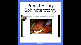 Precut Biliary Sphincterotomy [upl. by Butch]