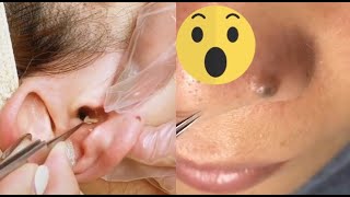 Ultimate Compilation of Satisfying Acne and Blackhead Removal Pops  Best Pimple Popping Moments [upl. by Cherey471]