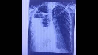 xray lungs Hydropneumothorax pleura effusionpneumothorax [upl. by Korrie896]