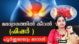 ഫിഷർ പൂർണ്ണമായും മാറാൻ Dr Gadha [upl. by Ycaj710]