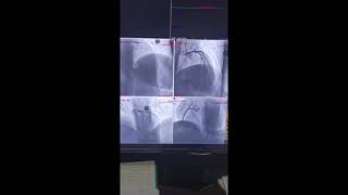 Cath Lab angiography Views Of Coronary cardiaccare cardiaccycle medicalstudent paramedical [upl. by Nosnev]