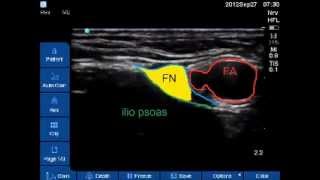 US guided femoral nerve block [upl. by Atilol796]