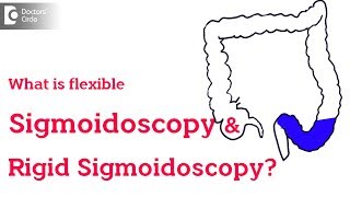 Rigid vs Flexible Sigmoidoscopy  Dr Rajasekhar M R [upl. by Charpentier635]