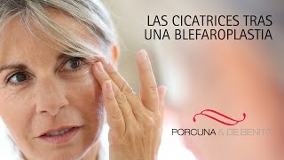 Las cicatrices tras una blefaroplastia [upl. by Nmutua]