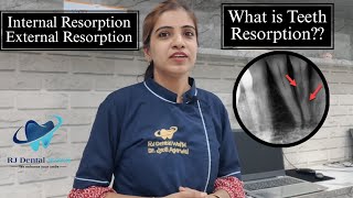 What is Teeth Resorption External amp Internal Resorption kya hota hai Dr Jyoti Agarwal [upl. by Kiraa600]