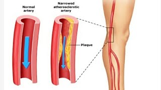 Claudication in legs  treatment  exercise  claudication Pathophysiology [upl. by Andris]