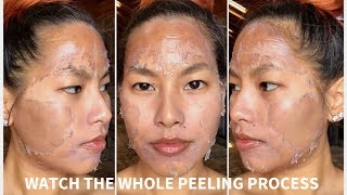 WATCH WHAT HAPPENS AFTER YOU GET A PEEL  7 DAY PEEL PROCESS [upl. by Hodess]