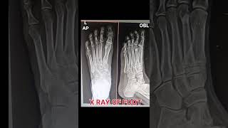 X ray of foot radiology [upl. by Forward142]