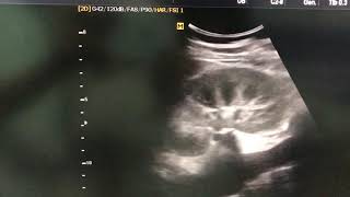 Papillary necrosis Diffusely Oedematous kidney with mild loss of corticomedullary differentiation [upl. by Jacobah]