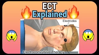 Electroconvulsive therapy ECT explained  How it is performed [upl. by Kathi]