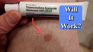 I Started Using Steroid Cream on My Psoriasis [upl. by Bills164]