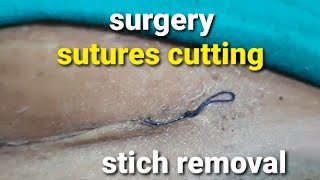 Stiches removal and dressing after cesarean section  घुलनशील टाँको को काटना  suture removal [upl. by Aretha]