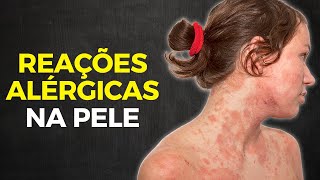 DERMATITE DE CONTATO  EVITE E TRATE REAÇÕES ALÉRGICAS NA PELE [upl. by Ahrat2]