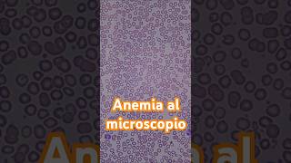 Así se ve la anemia al microscopio hematología anemia laboratorioclinico [upl. by Renelle761]