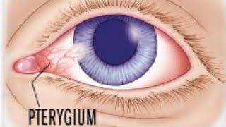 Pterygium  what is pterygium  treatment and surgery options [upl. by Grindlay]