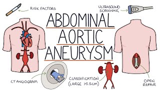 Aortic dissection AD Causes Signs and Symptoms Diagnosis and Treatment [upl. by Clardy144]