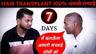 100 Real Truth Of Hair Transplant After 7 Days in India 2023 HAIR TRANSPLANT की सच्चाई [upl. by Nileuqaj512]