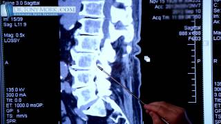 Spondylosis by Dr Tony Mork [upl. by Reema]