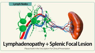 Lymphadenopathy and Splenic Focal Lesion [upl. by Liliane571]