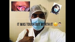 Chalazion removal Surgery  My Journey with Chalazia for 6 months amp Management Tips 👨🏻‍⚕️ [upl. by Lizzy]