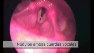 Lesiones en cuerdas vocales y laringe [upl. by Lerual818]