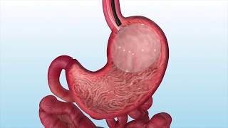 How the ORBERA™ gastric balloon is placed in the stomach [upl. by Nette997]