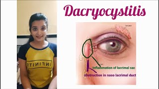 Dacryocystitis Part1 congenital Dacryocystitis  AK Khurana [upl. by Luap]