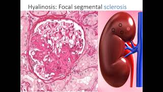 Glomerular Hyalinosis [upl. by Llerot259]