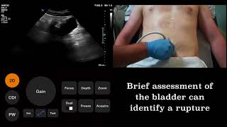 Ultrasound Tutorial FAST Focused Assessment with Sonography for Trauma scan  Radiology Nation [upl. by Henden]