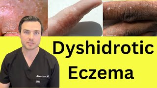 What is Dyshidrotic hand Eczema Causes and treatment [upl. by Marna]