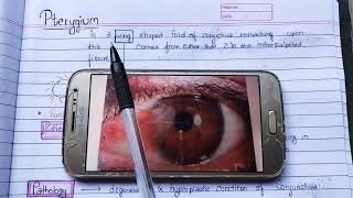 Pterygium theory exam notes AK Khurana [upl. by Emmerie654]