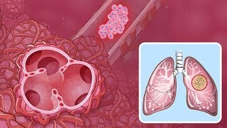 Understanding NonSmall Cell Lung Cancer [upl. by Yaras]