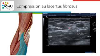 Compression du nerf médian au coude un cas clinique atypique [upl. by Sibby]