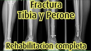 FRACTURA de TIBIA y PERONÉ Tratamiento desde la fase de INMOVILIZACIÓN [upl. by Alahc]