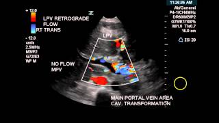 Color Doppler of Cavernous Transformation of the Portal Vein  Case Study [upl. by Hsejar]