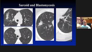 Oncological Imaging Practical Approach  Mimics of Malignancy Lung and pleura by Dr Luba Frank [upl. by Flam]