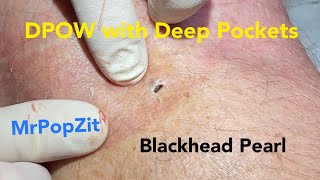 The Blackhead with deep pockets DPOW blackhead pearl extraction on posterior “popliteal” knee [upl. by Ymeon]