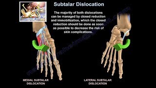 Subtalar Dislocation  Everything You Need To Know  Dr Nabil Ebraheim [upl. by Newfeld103]