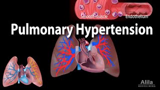 Pulmonary Hypertension Animation [upl. by Kellen459]