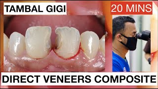 Step by Step Direct Veneers Composite Anterior Multiple Cases 20mins  General Dentist Griya RR [upl. by Chaiken768]