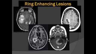 Brain Scans Lord of the Ring Enhancing Lesions 101 [upl. by Namia]