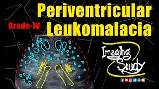 Periventricular Leukomalacia Grade IV  Ultrasound  Case 318 [upl. by Berger186]