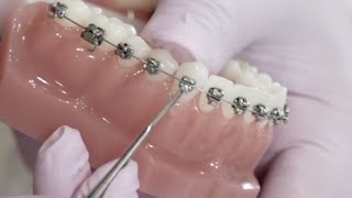 Damon self ligating orthodontic appliance Bracket opening and closing quick demonstration [upl. by Cirala]