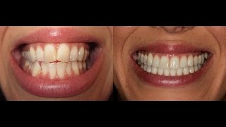 Invisalign Time Lapse UPDATED [upl. by Itch]