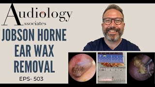 JOBSON HORNE EAR WAX REMOVAL  EP 503 [upl. by Dier673]