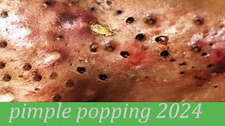 pimple popping 2024 new blackheads on nose pimple popping tiktok 4332 [upl. by Creight]