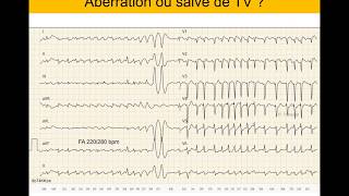 Tachycardie ventriculaire ou supraventriculaire  Quiz ECG Dr Taboulet [upl. by Scarito]